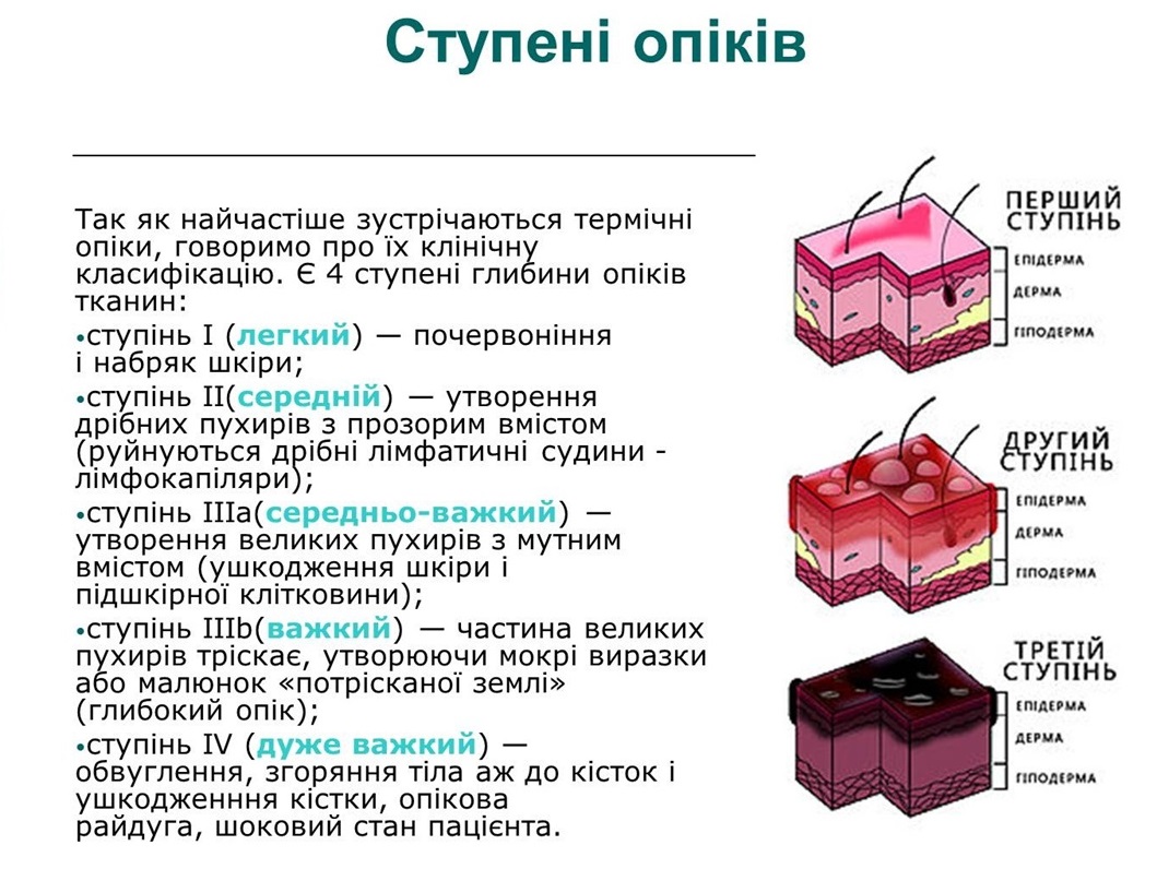 перша допомога при термічних опіках